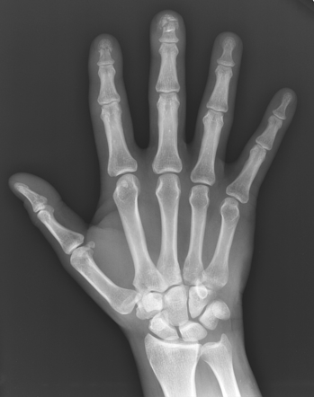 Phalangeal tuft fractures | Image | Radiopaedia.org