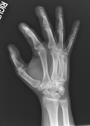 Phalangeal tuft fractures | Image | Radiopaedia.org