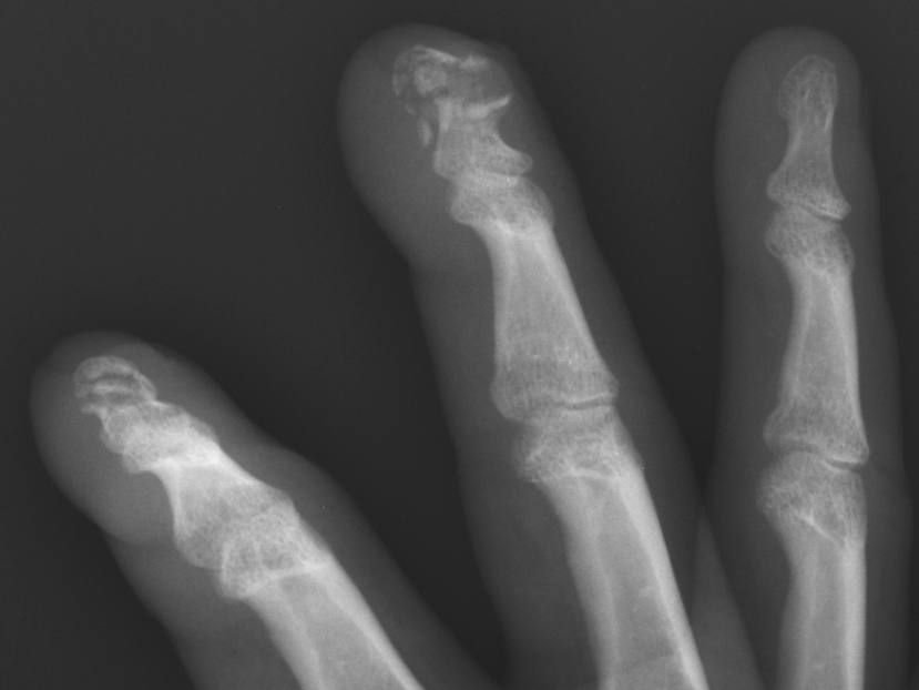 Phalangeal tuft fractures | Image | Radiopaedia.org