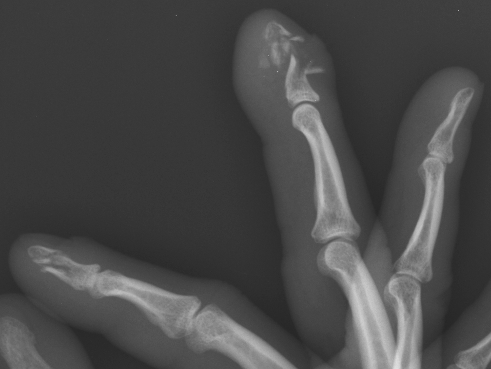 Phalangeal tuft fractures | Image | Radiopaedia.org