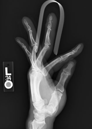 Phalangeal tuft fractures | Image | Radiopaedia.org