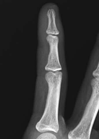 Phalangeal tuft fracture | Image | Radiopaedia.org