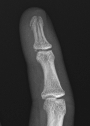 Phalangeal tuft fracture | Image | Radiopaedia.org