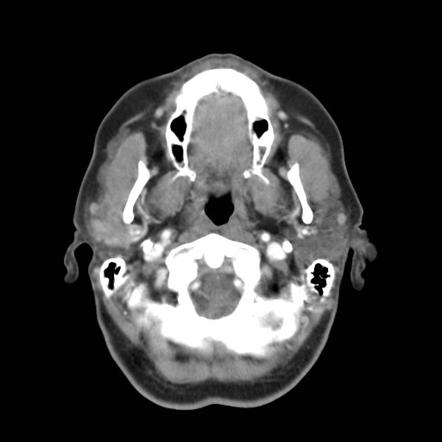 carcinoma adenoid cystic parotid gland salivary glands radiology radiopaedia mucoepidermoid