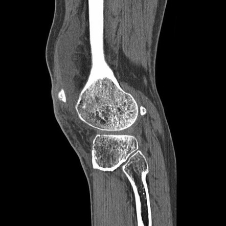 Lipoma arborescens | Radiology Reference Article | Radiopaedia.org