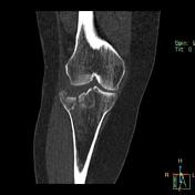 Medial tibial plateau stress fracture icd 10