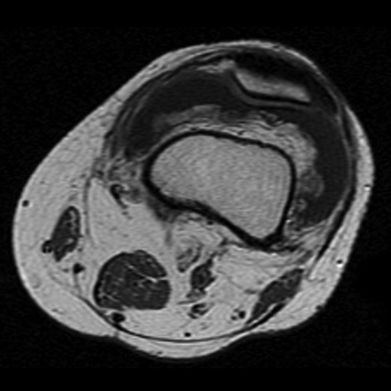 Lipoma arborescens | Image | Radiopaedia.org