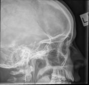 Paranasal Sinuses And Facial Bones Radiography Radiology Reference Article Radiopaedia Org