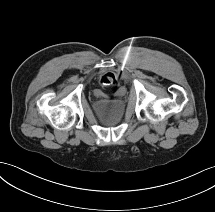 CT guided biopsy | Radiology Reference Article | Radiopaedia.org