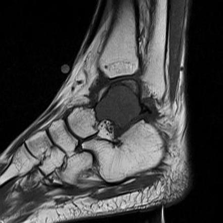 Aneurysmal bone cyst of talus | Image | Radiopaedia.org