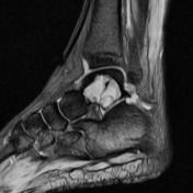 Aneurysmal bone cyst | Radiology Reference Article | Radiopaedia.org