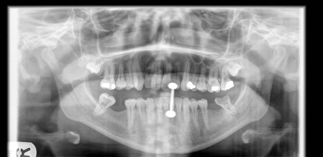 Periodontal lucency | Radiology Case | Radiopaedia.org