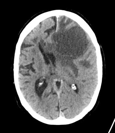 Brain metastasis from lung cancer | Image | Radiopaedia.org