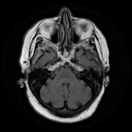 Ecchordosis physaliphora | Image | Radiopaedia.org