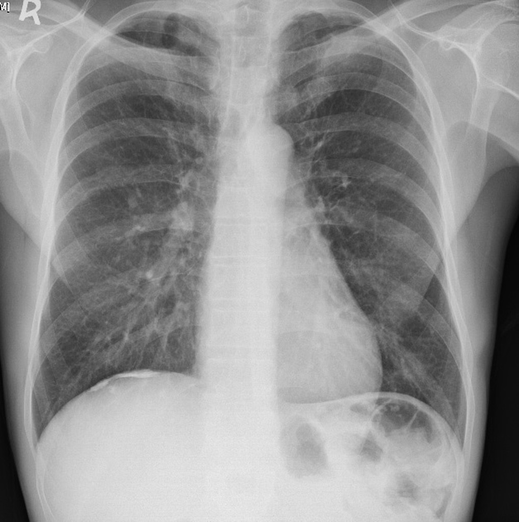 Calcified Pleural Plaque Radiology Case Radiopaedia Org