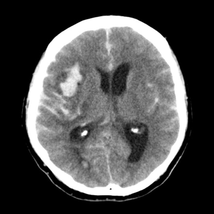 Subarachnoid haemorrhage - MCA aneurysm rupture | Radiology Case ...