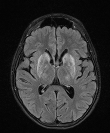 Symmetrical cerebral T2 hyperintensities | Radiology Reference Article ...