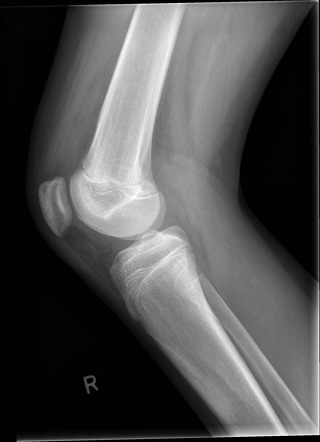 Normal knee | Radiology Case | Radiopaedia.org