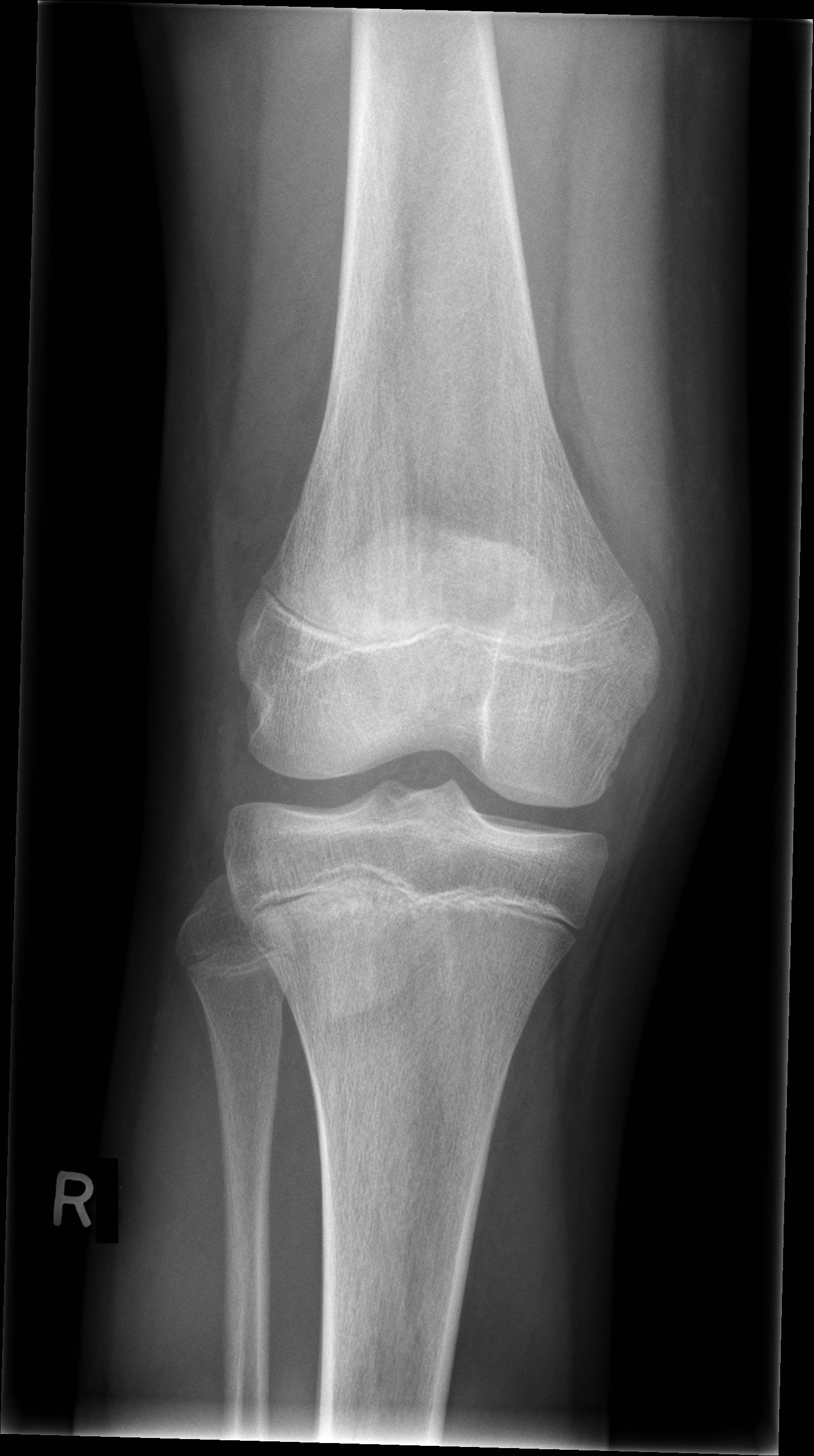 Normal knee | Image | Radiopaedia.org