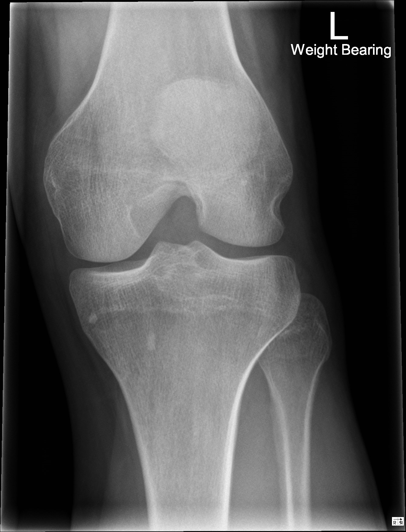 Normal knee | Image | Radiopaedia.org