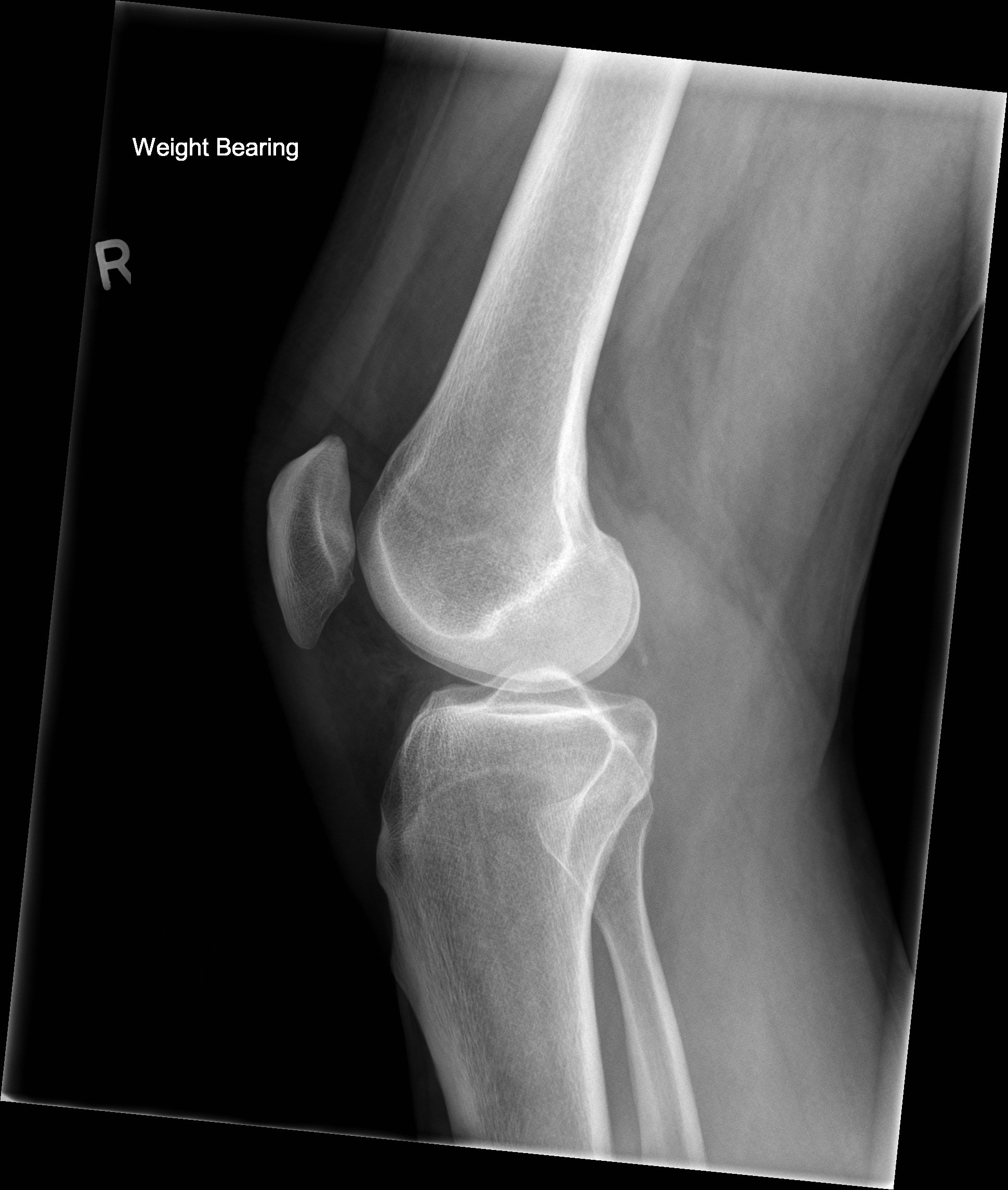 knee cap xray