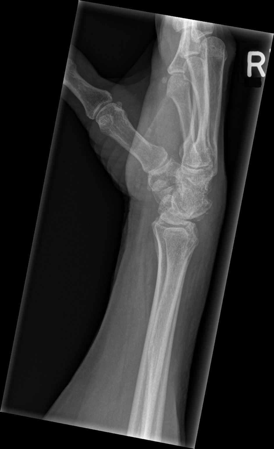 Fractured radius | Image | Radiopaedia.org