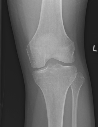 Segond fracture | Radiology Case | Radiopaedia.org