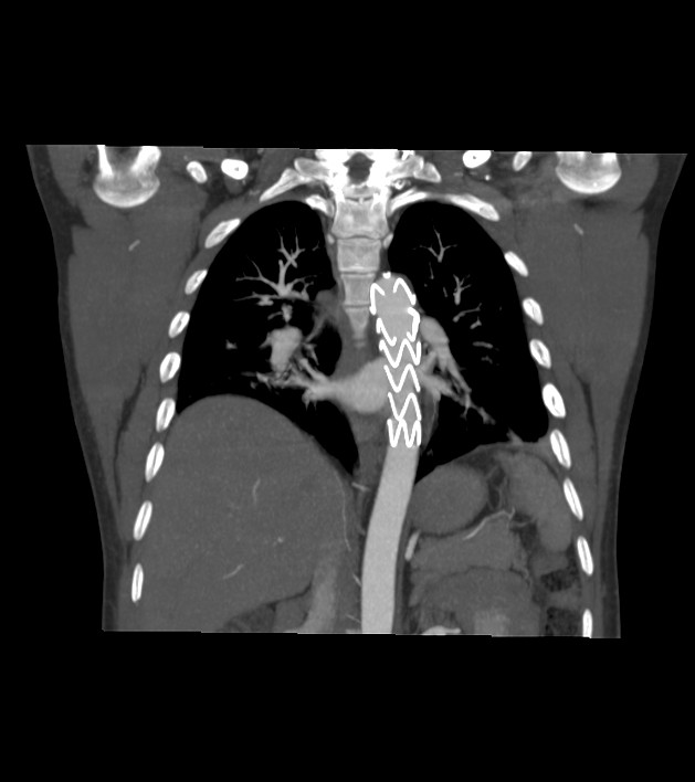 Traumatic aortic injury | Image | Radiopaedia.org