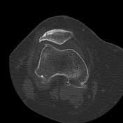 patella | Search | Radiopaedia.org