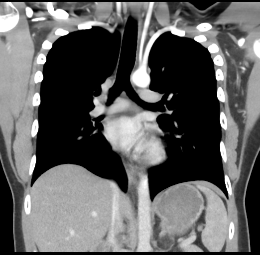 Tuberculous cervical lymphadenitis | Image | Radiopaedia.org