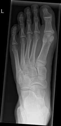 Ankle and foot radiography | Radiology Reference Article | Radiopaedia.org