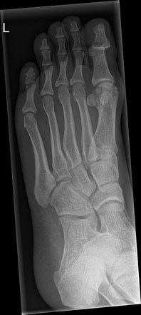 Ankle and foot radiography | Radiology Reference Article | Radiopaedia.org