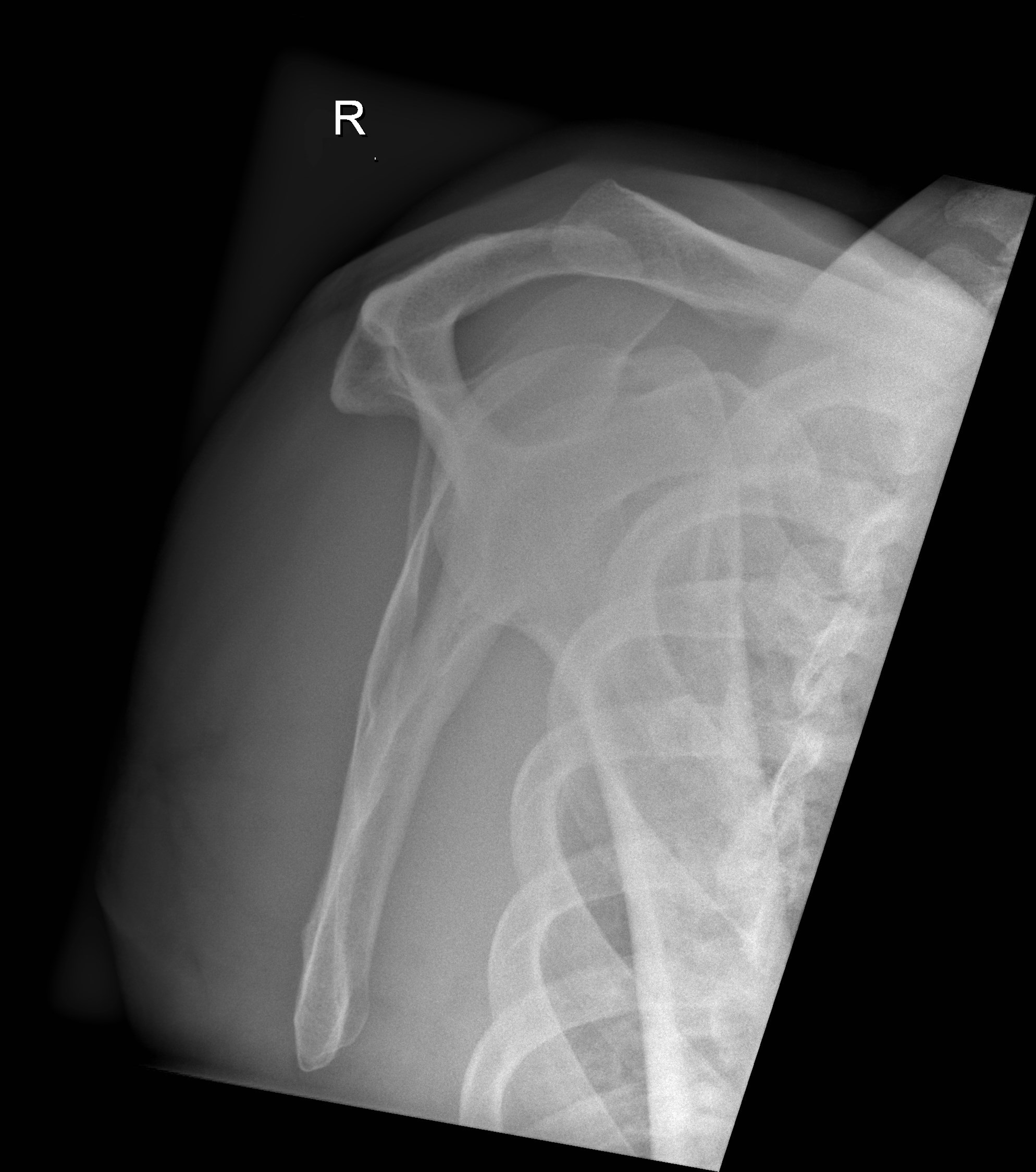 Normal Shoulder Radiograph Image Radiopaedia Org