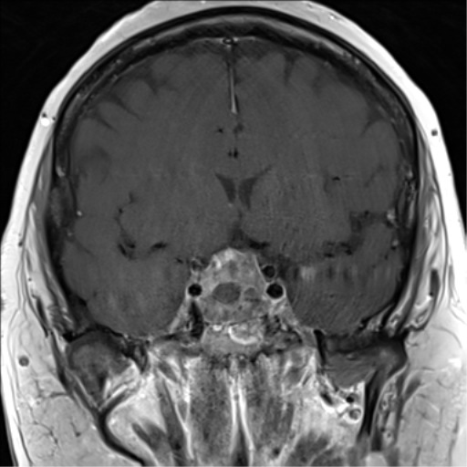 Pituitary Macroadenoma | Image | Radiopaedia.org