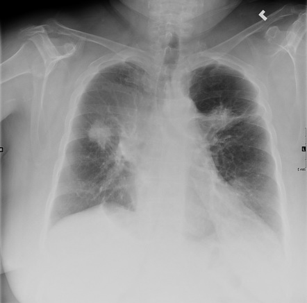 Lung atelectasis | Radiology Reference Article | Radiopaedia.org