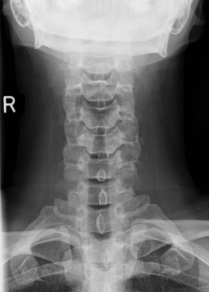 cervical spine x ray