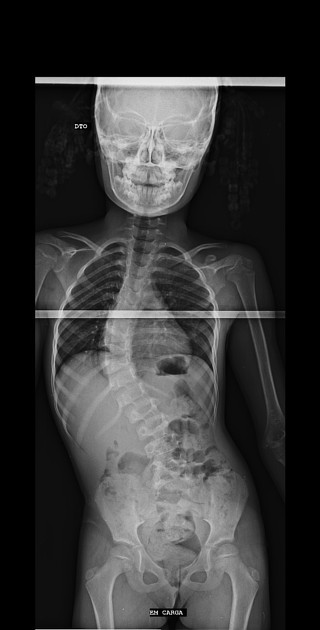 Horizontal gaze palsy with progressive scoliosis | Radiology 