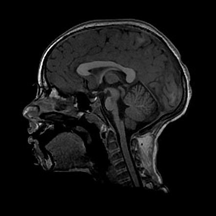 Horizontal Gaze Palsy With Progressive Scoliosis | Radiology Reference ...