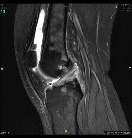 ACL mucoid degeration with cystic changes | Radiology Case ...