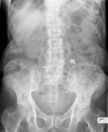 Paget disease - pelvis | Radiology Case | Radiopaedia.org