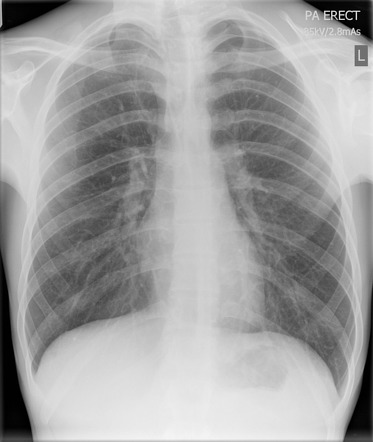 Pneumothorax | Radiology Reference Article | Radiopaedia.org