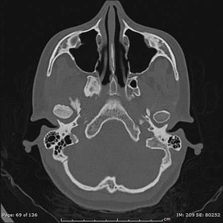 Fibrous dysplasia - mandible | Image | Radiopaedia.org