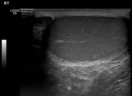 Primary mediastinal yolk sac tumor | Image | Radiopaedia.org