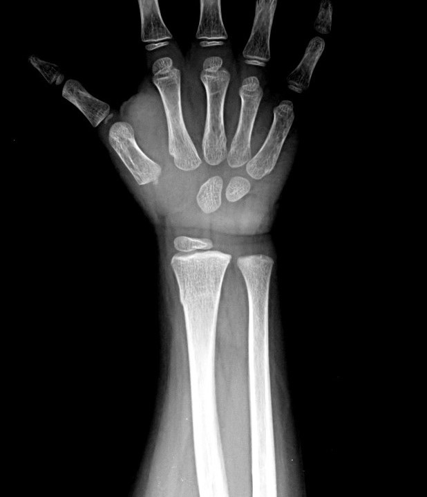 Torus fracture | Image | Radiopaedia.org