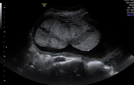 Subamniotic hemorrhage | Radiology Reference Article | Radiopaedia.org