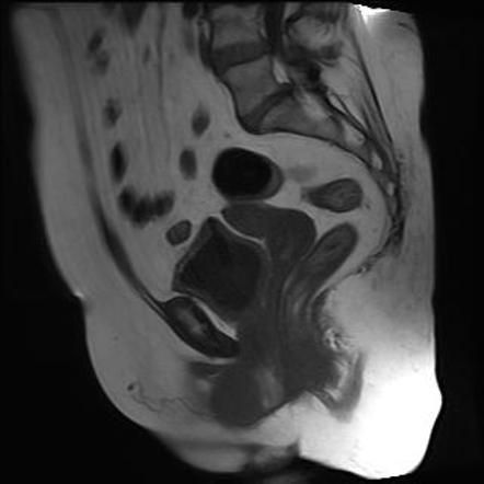 Urethral cancer (female) | Image | Radiopaedia.org