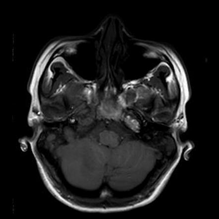 Complicated coalescent mastoiditis | Image | Radiopaedia.org