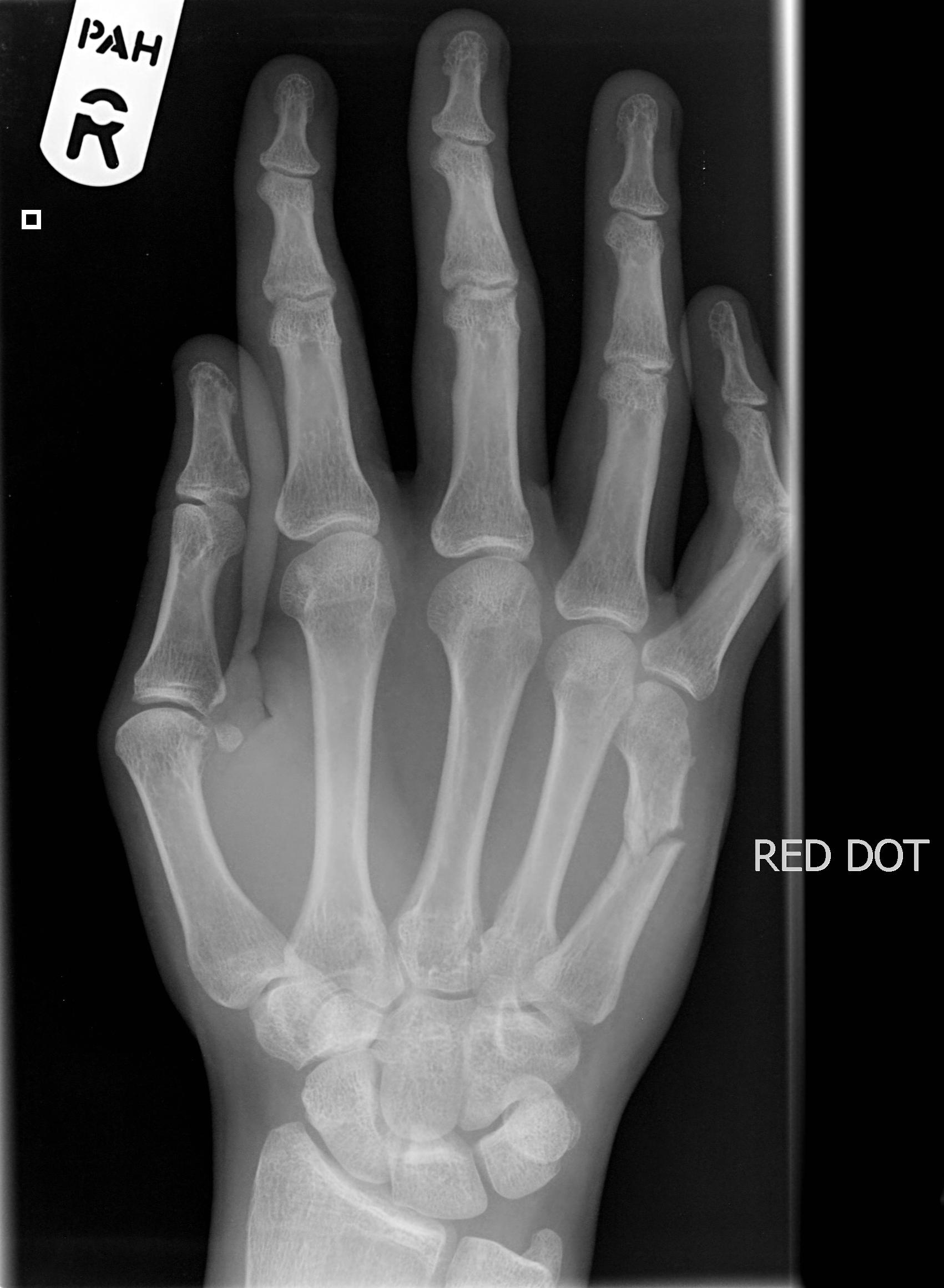 Fifth Metacarpal Fracture | Image | Radiopaedia.org