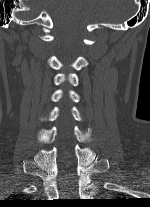 Alar ligament calcification (right): mimicking a fracture | Image ...