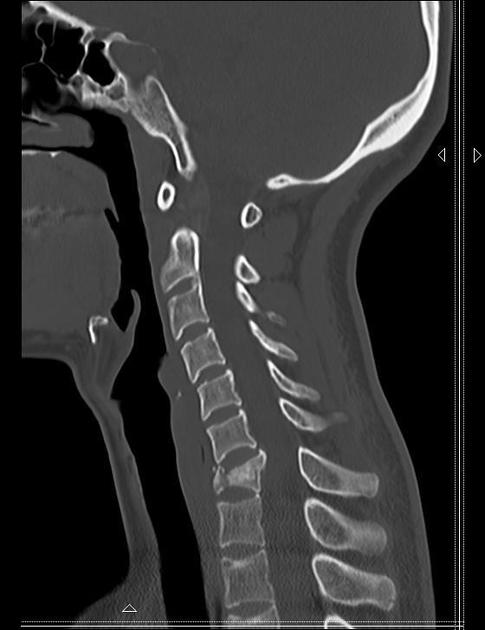 Hyperflexion Cervical Spine Injury Flexion Teardrop Fracture Radiology Case Radiopaedia Org